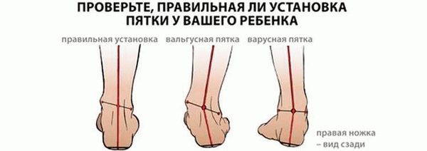 Что такое ретикулярный варикоз вен